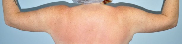 Patient Brachioplasty | Arm Lift Thumbnail After 3