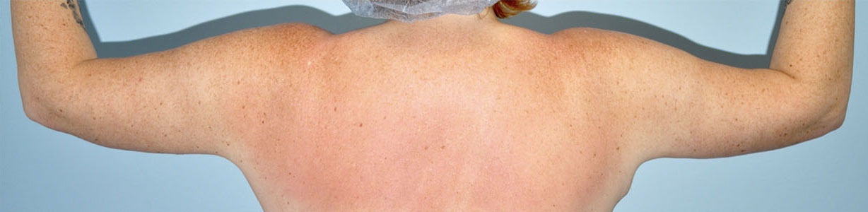 Patient Brachioplasty | Arm Lift Before 3