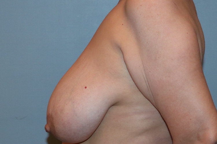 Patient Breast Lift Before 2