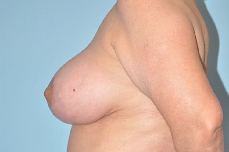 Patient Breast Lift Before 2