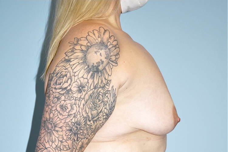Patient Breast Lift Before 2