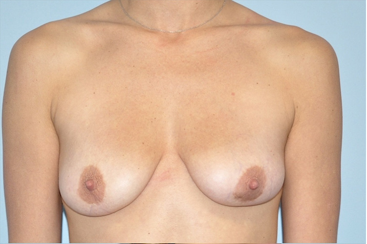 Patient Breast Lift Before 0