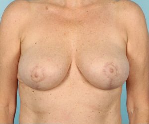 Patient Breast Reduction After 0