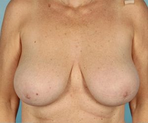 Patient Breast Reduction Before 0
