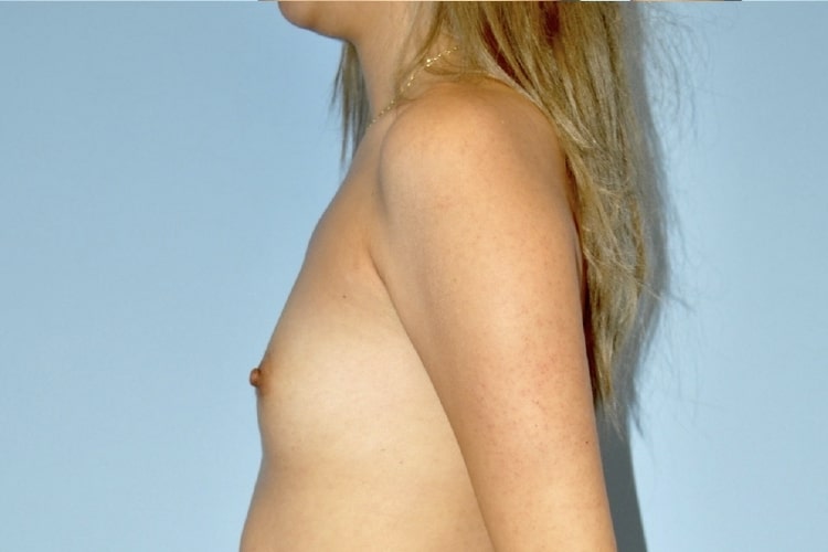 Patient Breast Augmentation Before 2