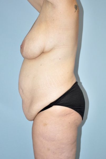 Patient Tummy Tuck Before 2