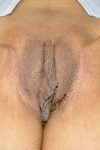 Patient Vaginal Rejuvenation Thumbnail Before 1