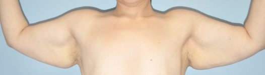 Patient Brachioplasty | Arm Lift Thumbnail Before 0