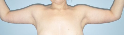 Patient Brachioplasty | Arm Lift Thumbnail After 0