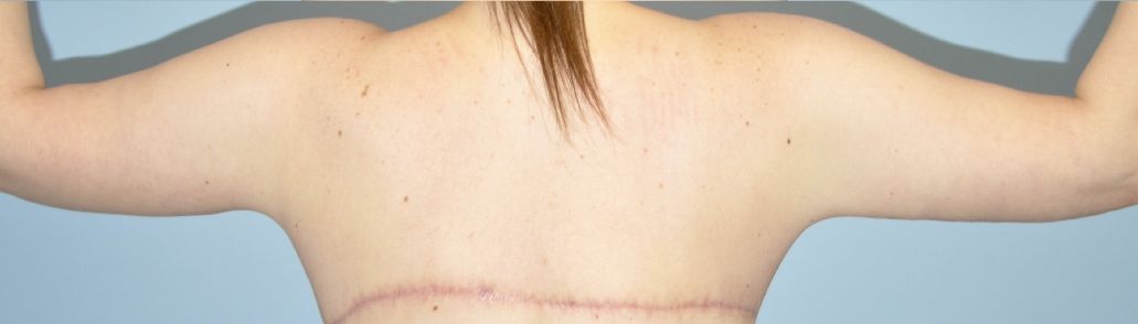 Patient Brachioplasty | Arm Lift Before 1