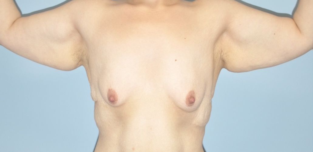 Patient Brachioplasty | Arm Lift Before 2