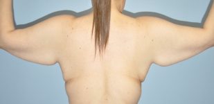 Patient Brachioplasty | Arm Lift Thumbnail Before 4