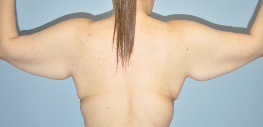 Patient Brachioplasty | Arm Lift Before 4