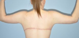 Patient Brachioplasty | Arm Lift Thumbnail After 4