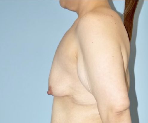 Patient Breast Augmentation Mastopexy Before 2