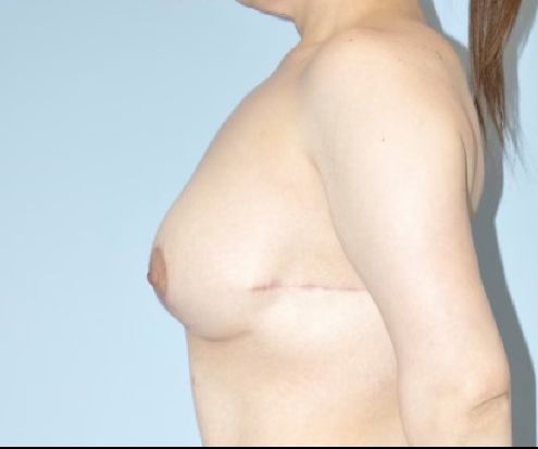 Patient Breast Augmentation Mastopexy Before 2