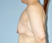 Patient Breast Lift Thumbnail Before 2