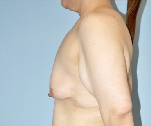 Patient Breast Lift Before 2