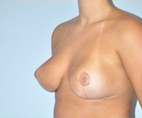 Patient Breast Lift Before 1