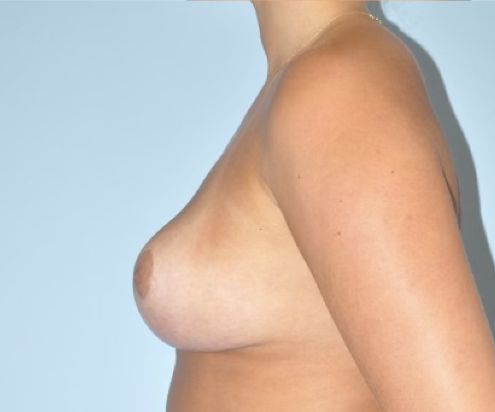 Patient Breast Lift Before 2