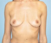 Patient Breast Implant Revision Thumbnail After 0