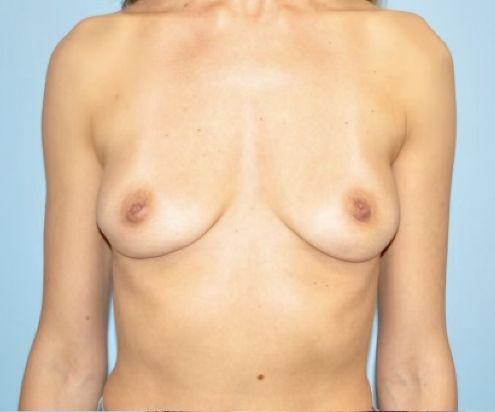 Patient Breast Implant Revision Before 0