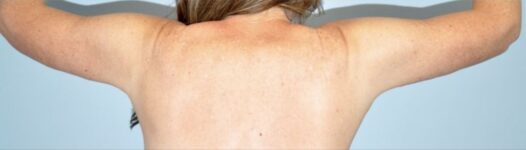 Patient Brachioplasty | Arm Lift Thumbnail After 1