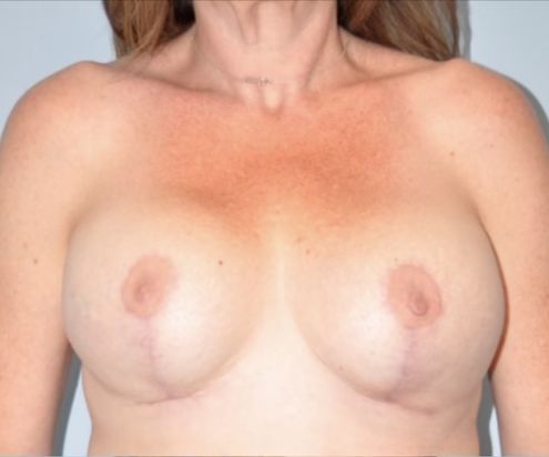 Patient Breast Implant Revision Before 0