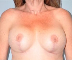 Patient Breast Lift After 0