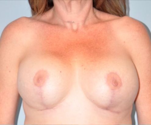 Patient Breast Lift Before 0