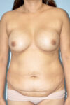 Patient Tummy Tuck Thumbnail Before 0