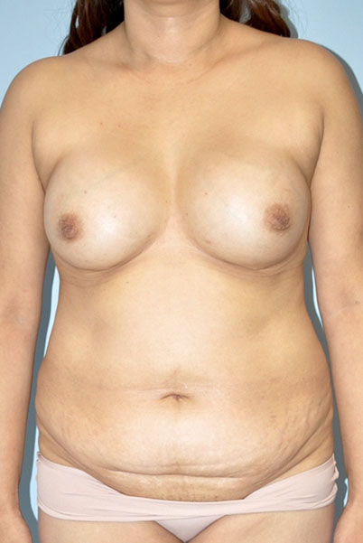 Patient Tummy Tuck Before 0