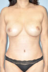Patient Tummy Tuck Thumbnail After 0