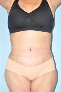 Patient Tummy Tuck After 0