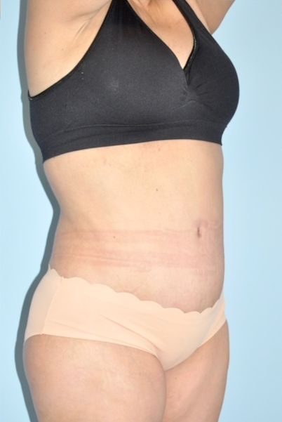 Patient Tummy Tuck Before 1