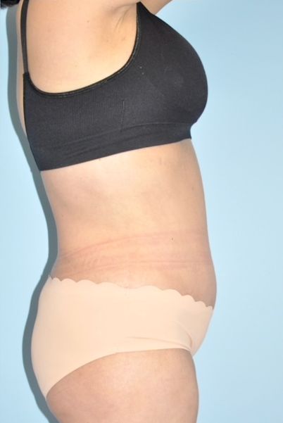 Patient Tummy Tuck Before 2