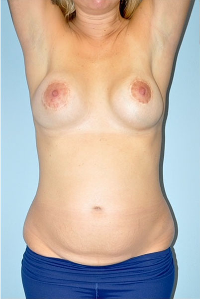 Patient Tummy Tuck Before 0