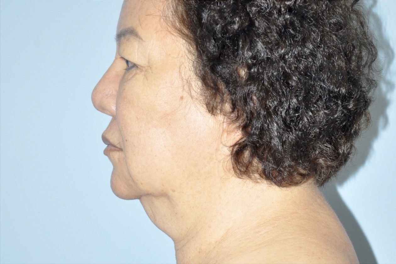 Patient Liposuction Before 2