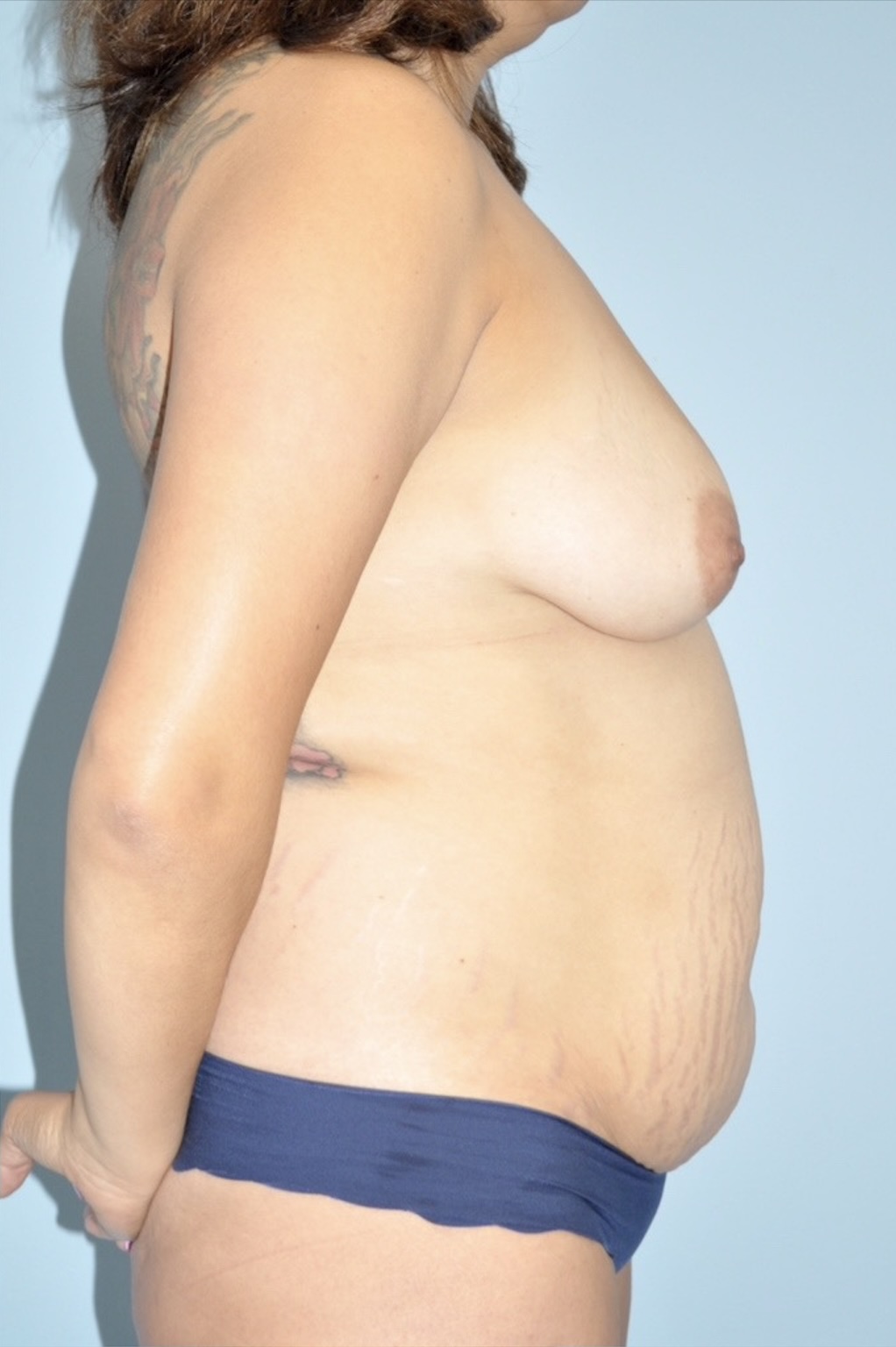 Patient Liposuction Before 2