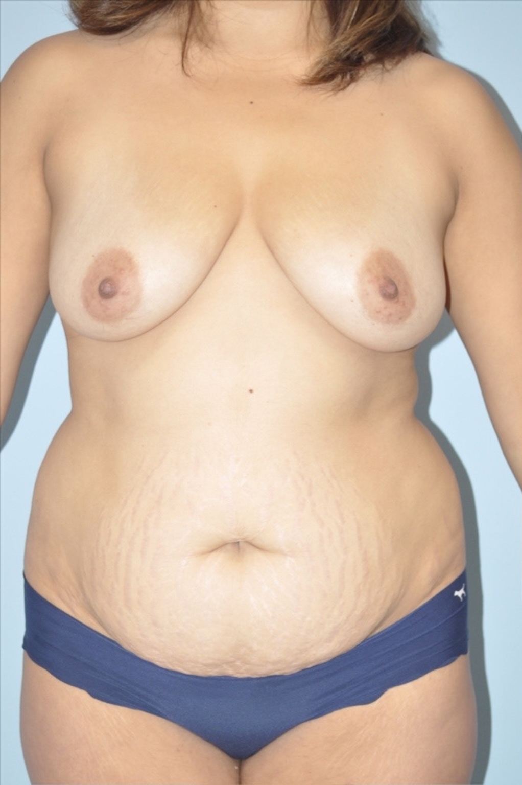 Patient Liposuction Before 0