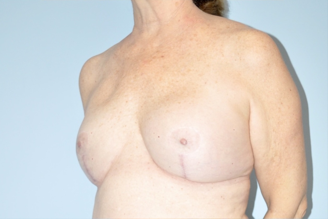 Patient Breast Implant Revision Before 3