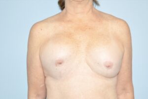 Patient Breast Implant Revision Before 0