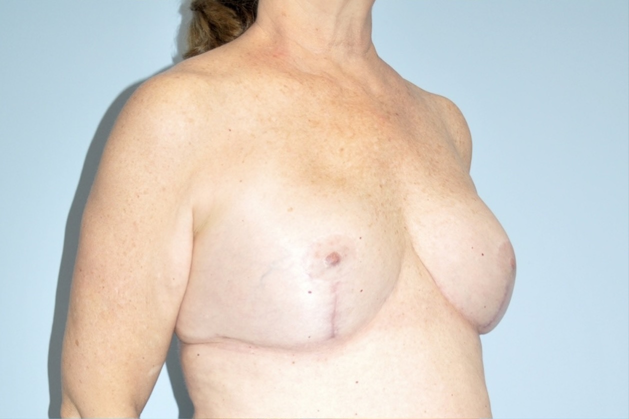 Patient Breast Implant Revision Before 1