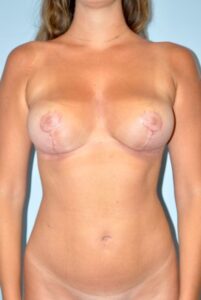 Patient Liposuction After 0