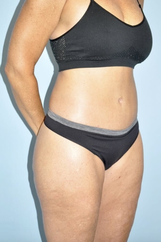 Patient Lower Body Lift Before 1