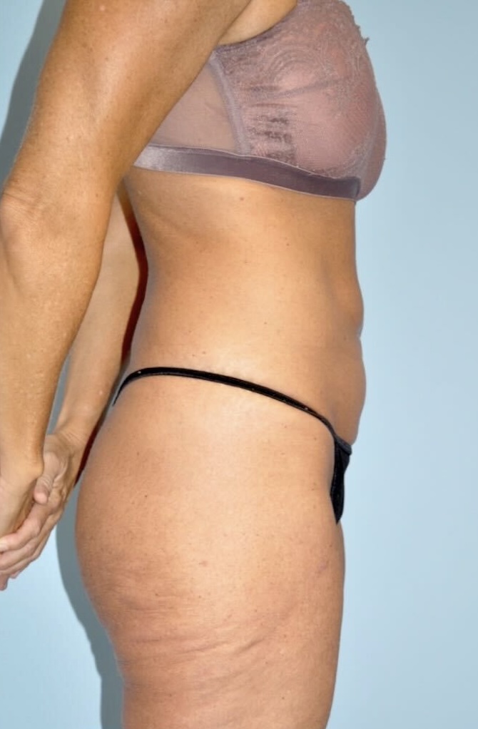 Patient Lower Body Lift Before 2