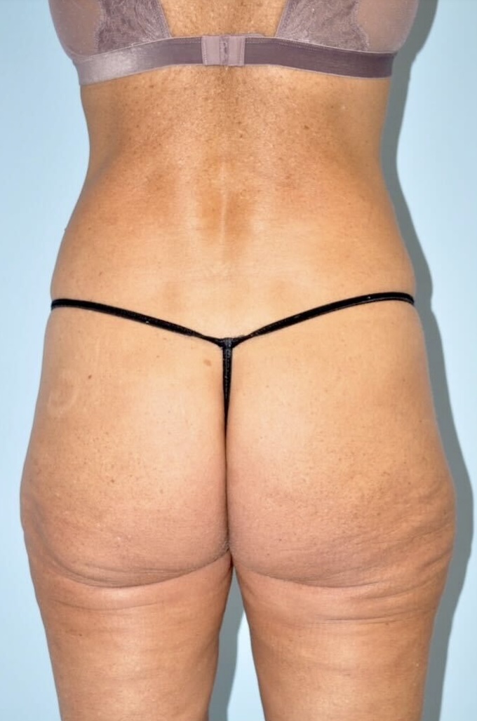 Patient Lower Body Lift Before 4