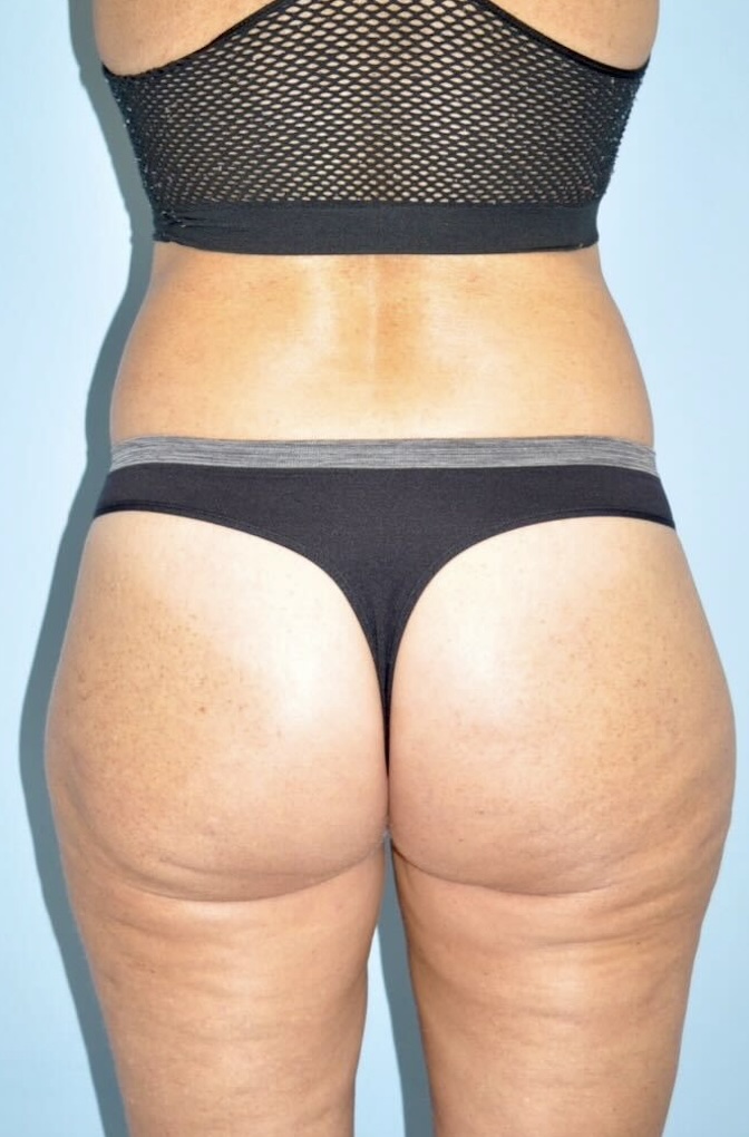 Patient Lower Body Lift Before 4