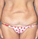 Patient Lower Body Lift Thumbnail Before 5