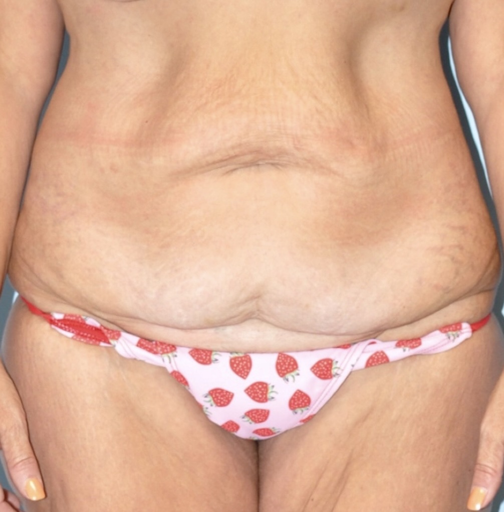 Patient Lower Body Lift Before 5